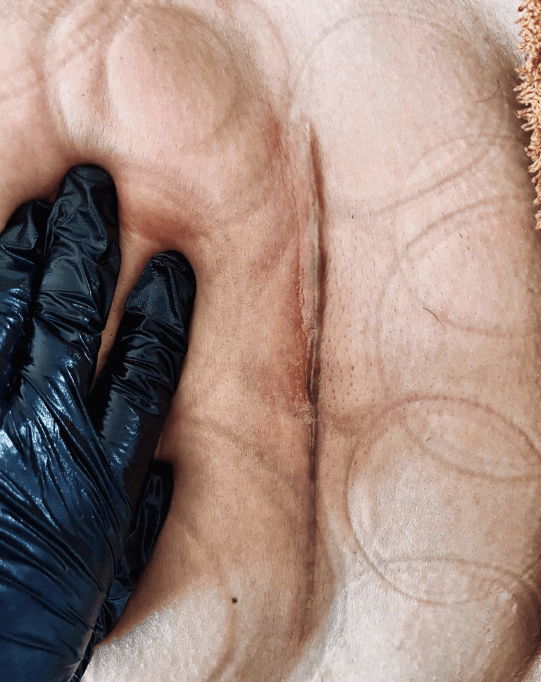 Keizersnede Littekens herstel bij Cupping barneveld